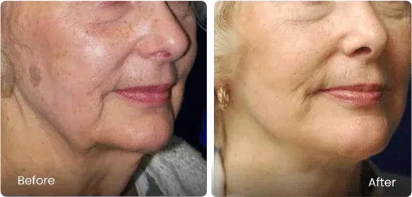 Before and After Image: Facelift - right-front-oblique