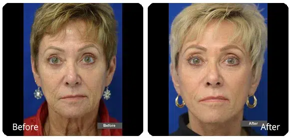 Before and After Image: Facelift - front