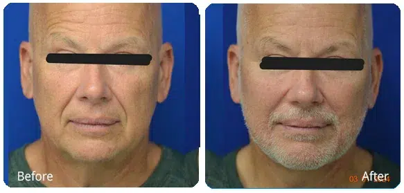 Before and After Image: Facelift - front