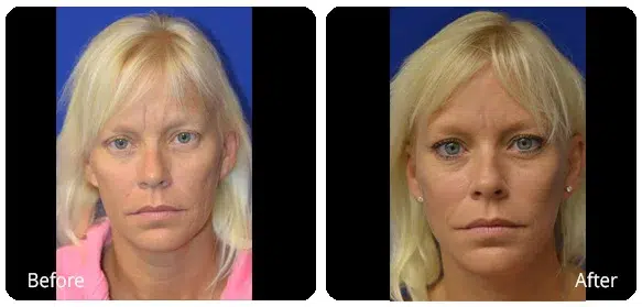 Before and After Image: Facelift - front