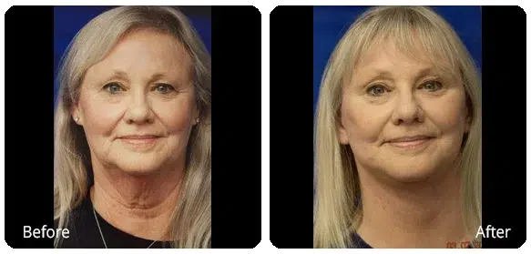 Before and After Image: Facelift - front