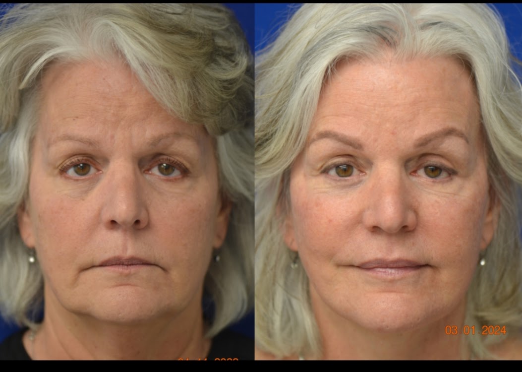 Before and After Image: Facelift - front