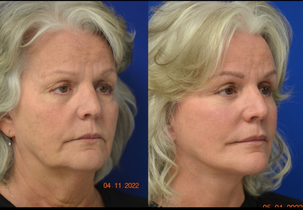 Before and After Image: Facelift - right-front-oblique