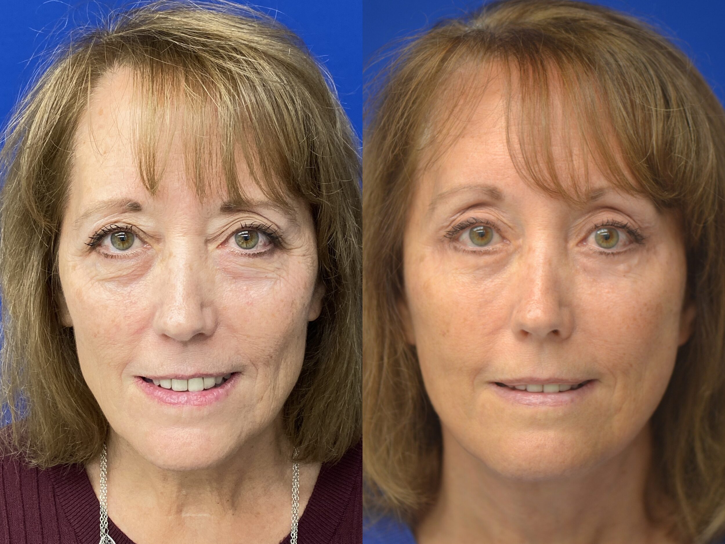 Before and After Image: Facelift - front
