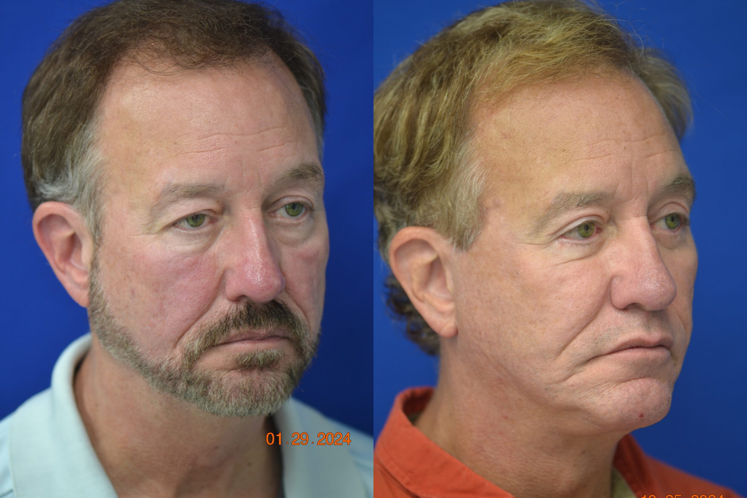 Before and After Image: Facelift - right-front-oblique