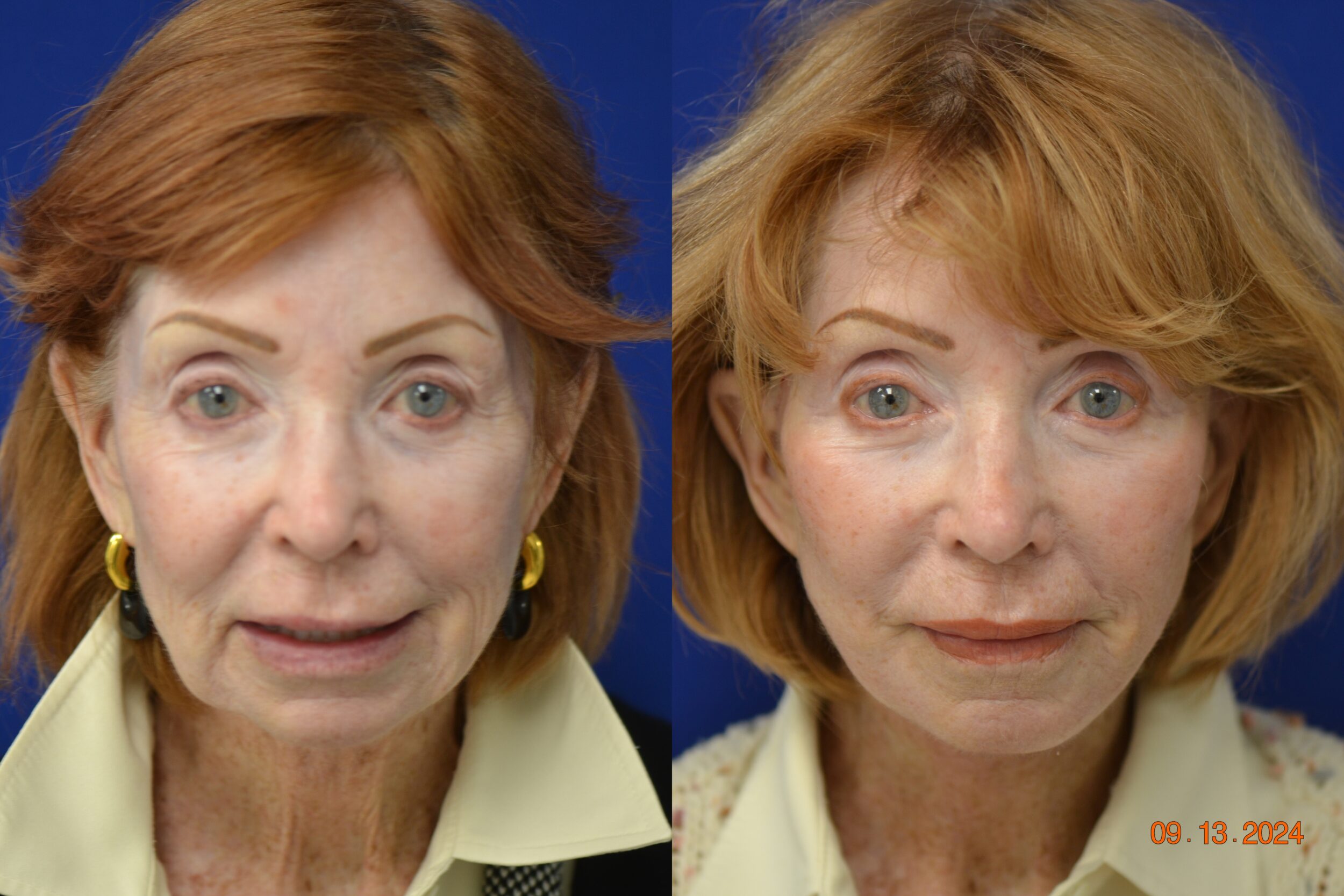 Before and After Image: Facelift - front