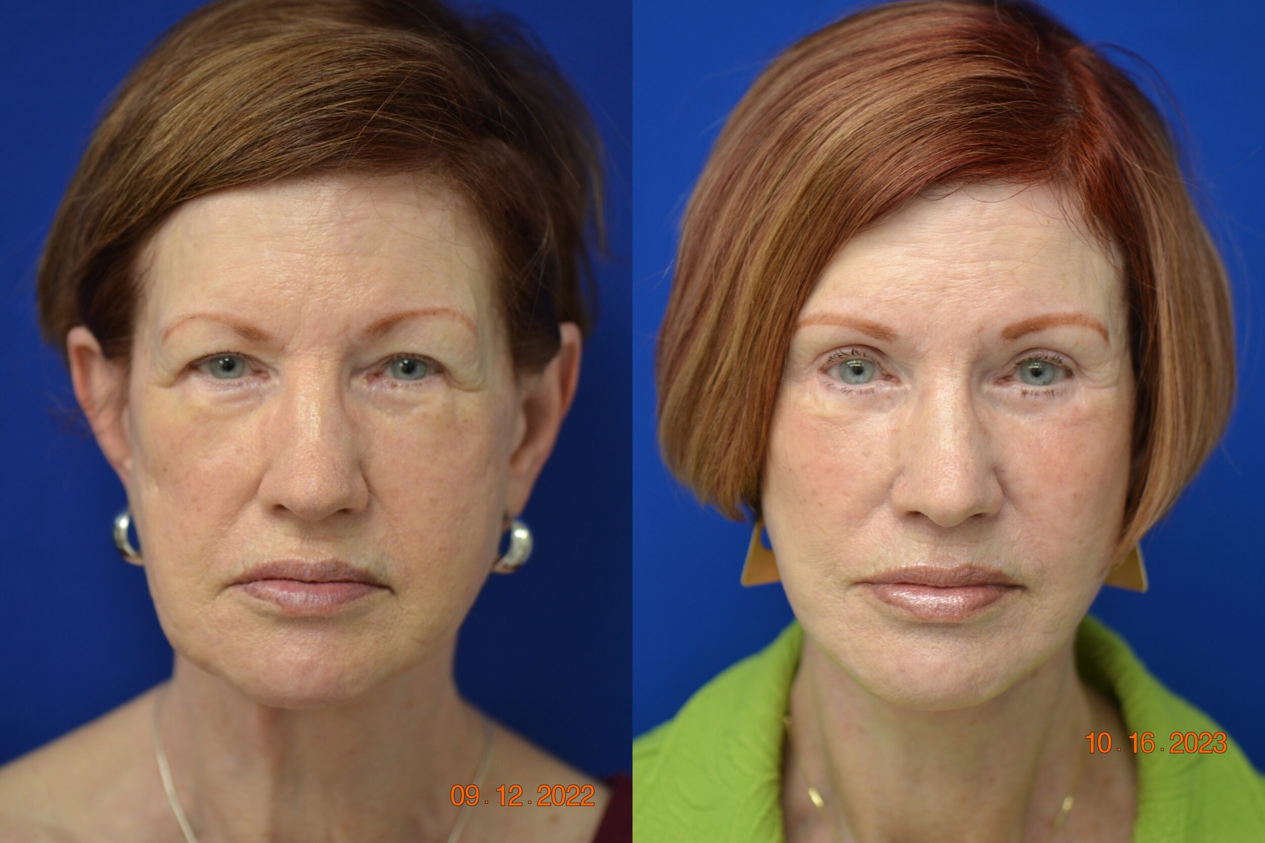 Before and After Image: Facelift - front