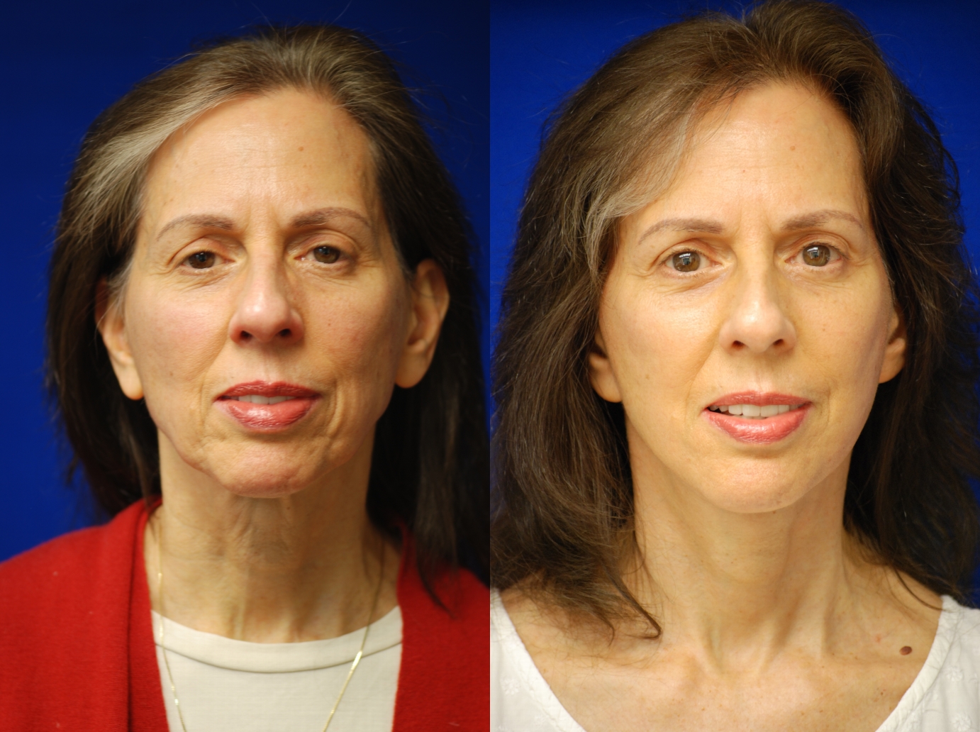 Before and After Image: Facelift - front