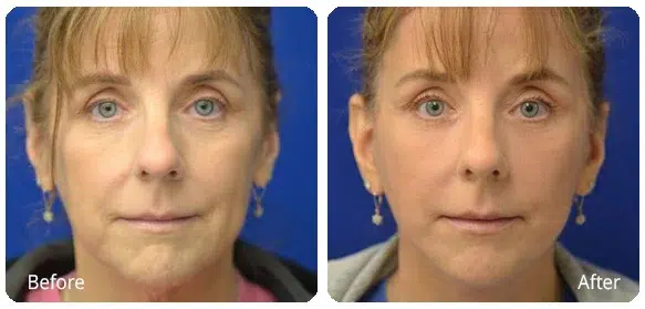 Before and After Image: Facelift - front
