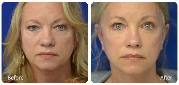 Before and After Image: Facelift - front