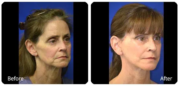 Before and After Image: Facelift - right-front-oblique