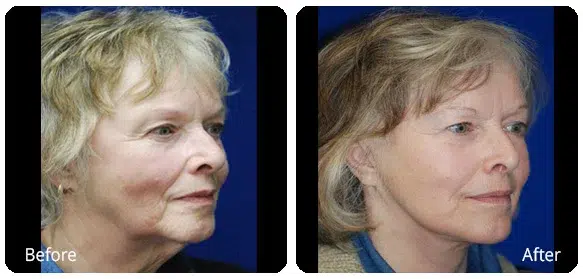 Before and After Image: Facelift - right-front-oblique