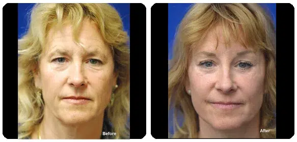 Before and After Image: Facelift - front