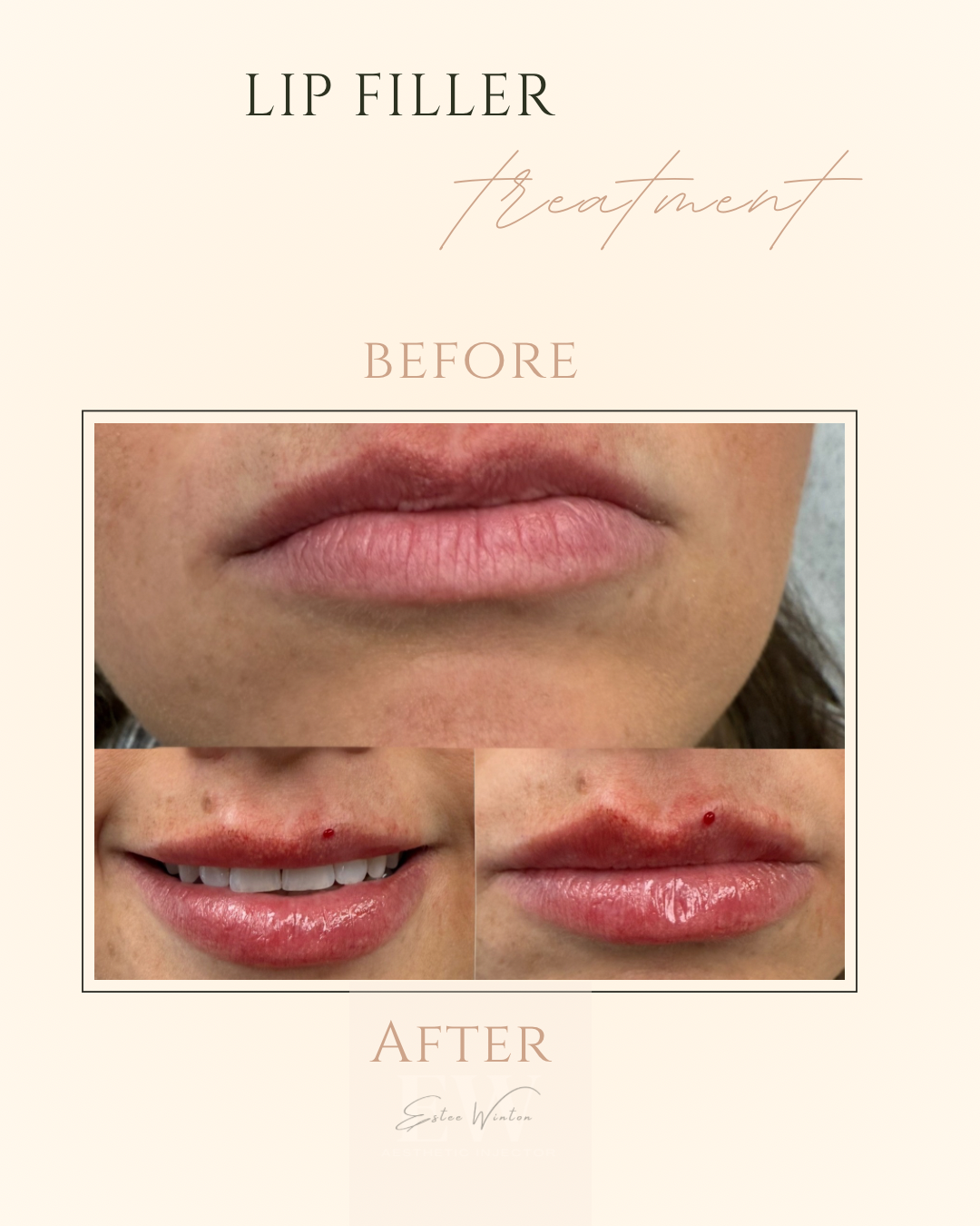 Before and After Image: Filler - front