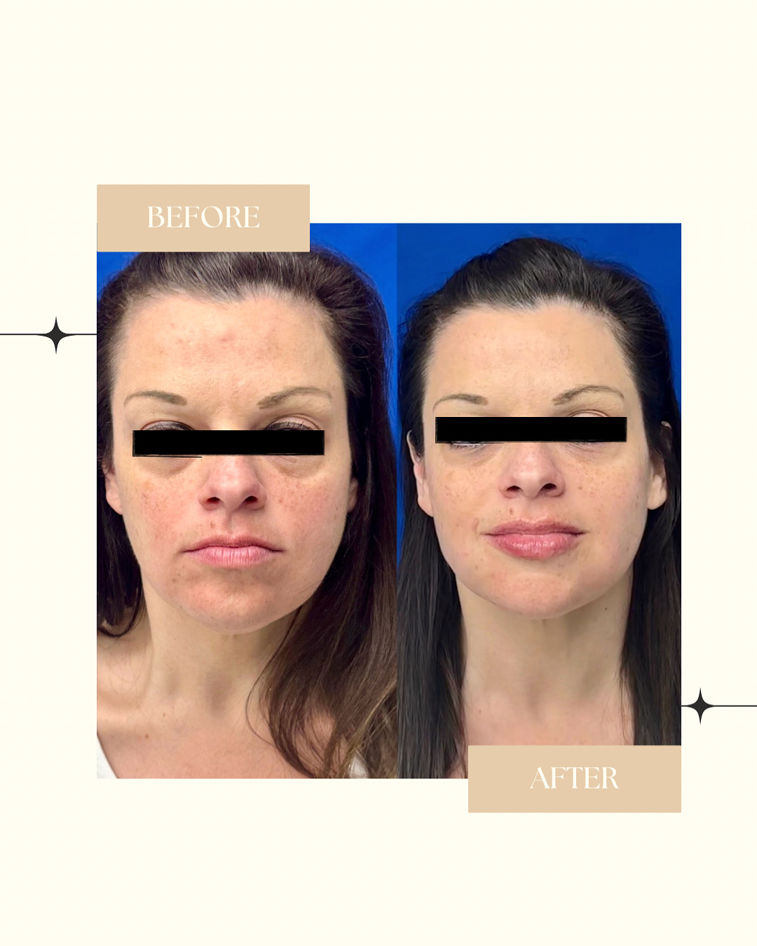 Before and After Image: Filler - front