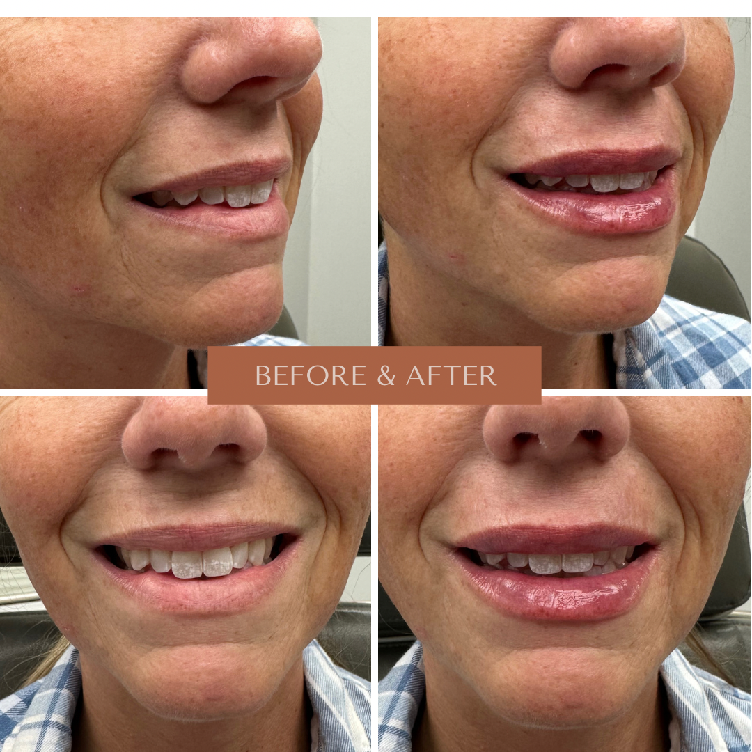 Before and After Image: Filler - other