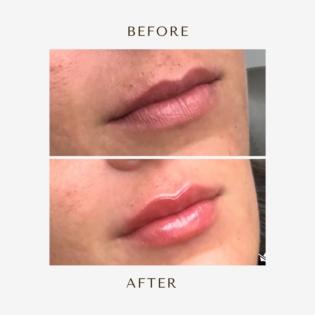 Before and After Image: Filler - right-front-oblique
