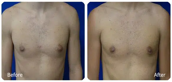 Before and After Image: Gynecomastia - front