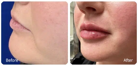 Before and After Image: Injectables - left-front-oblique