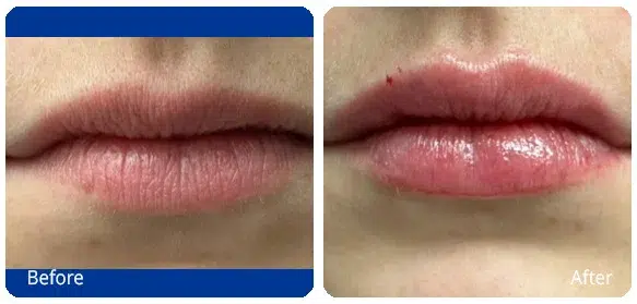 Before and After Image: Injectables - front