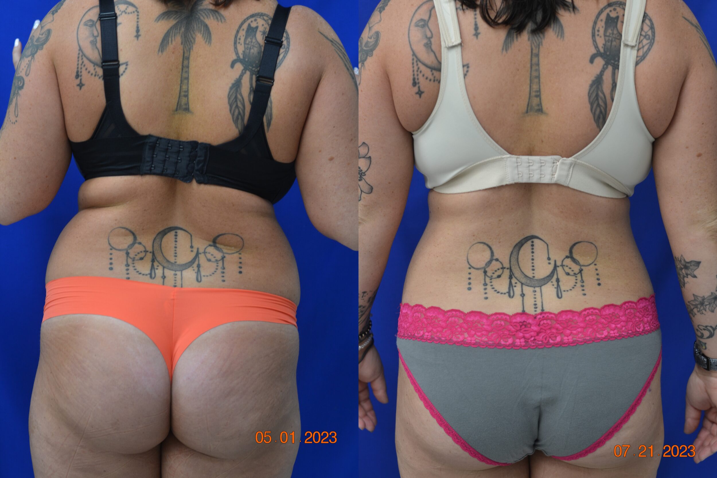 Before and After Image: Liposuction - back