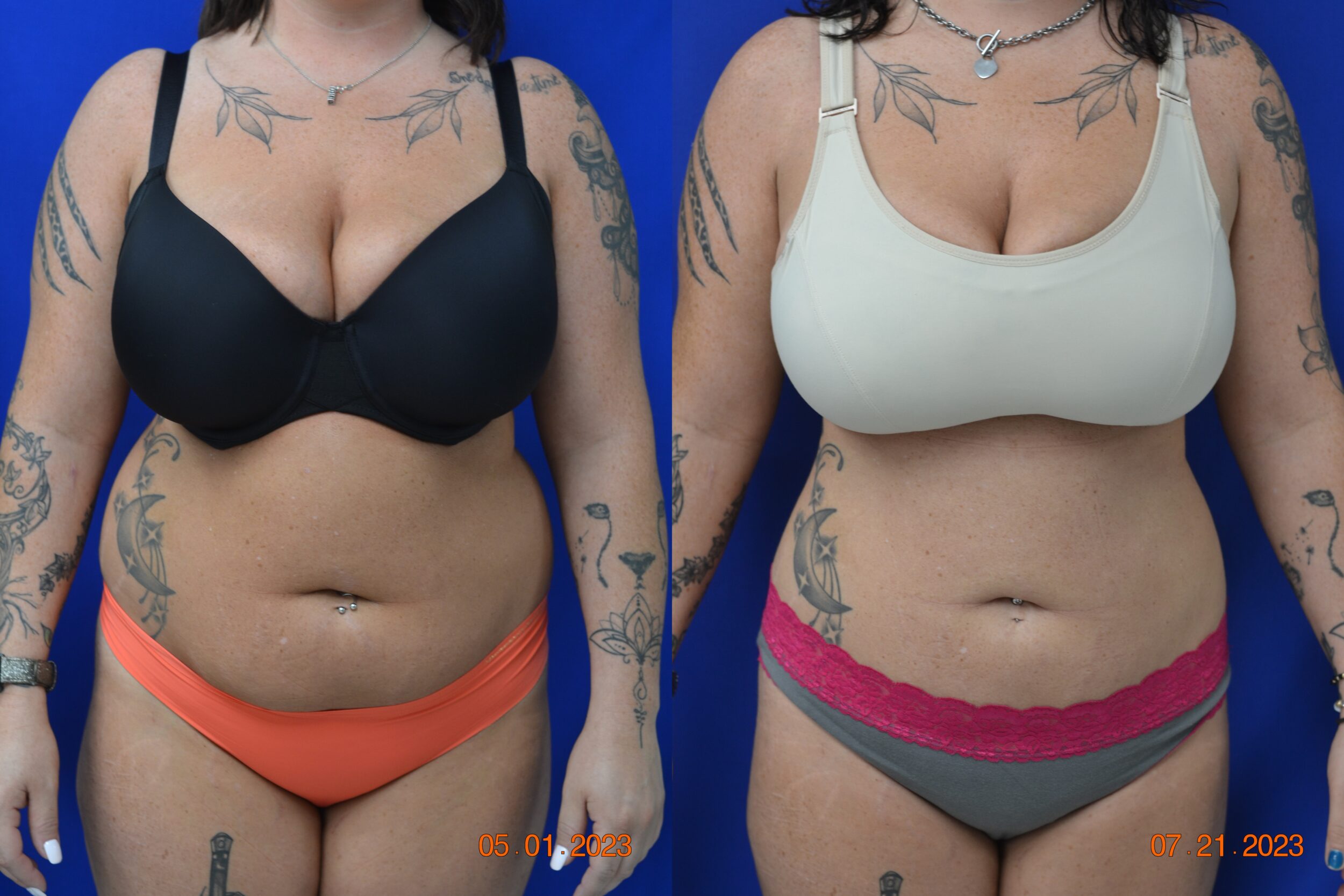 Before and After Image: Liposuction - front