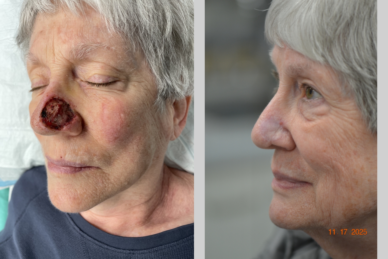 Before and After Image: MOHS Closure - left-front-oblique