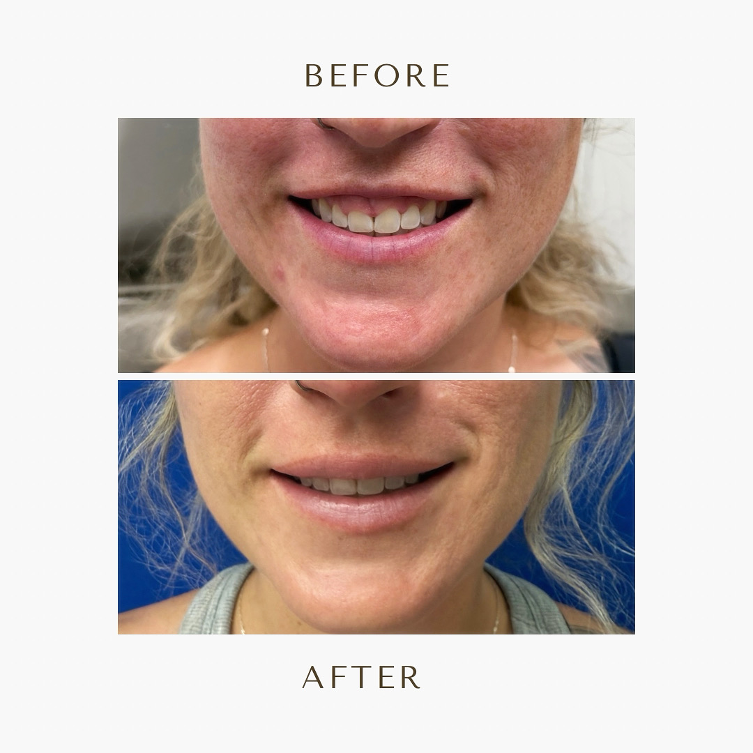 Before and After Image: Botox - front