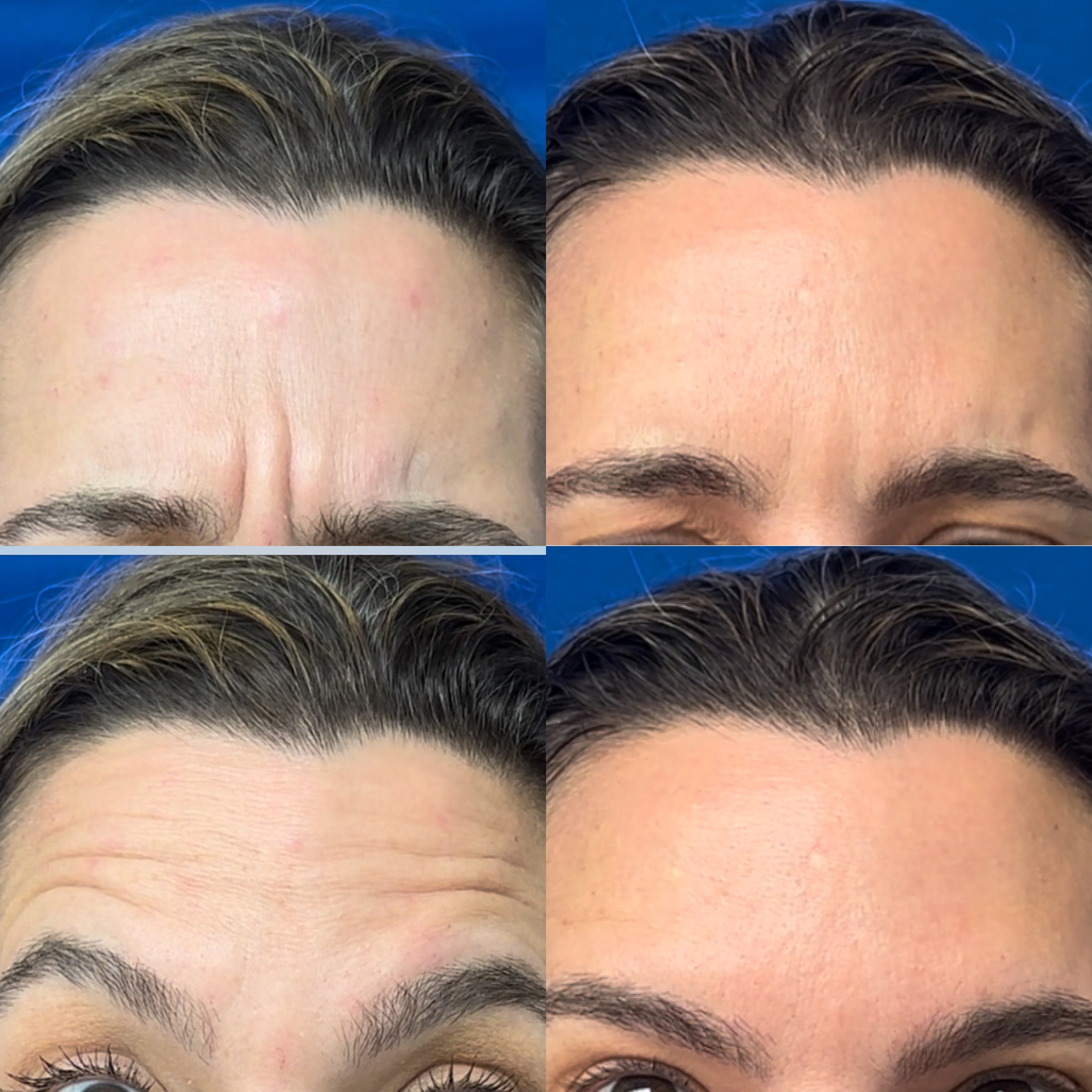 Before and After Image: Botox - front