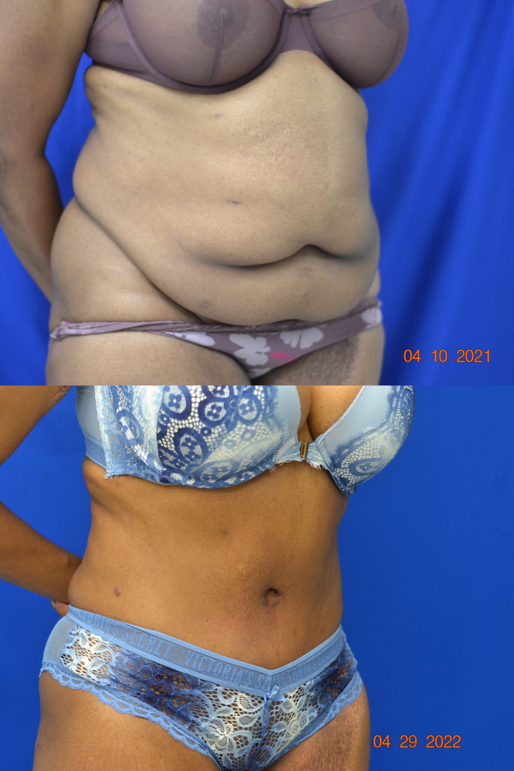 Before and After Image: Abdominoplasty - right-front-oblique