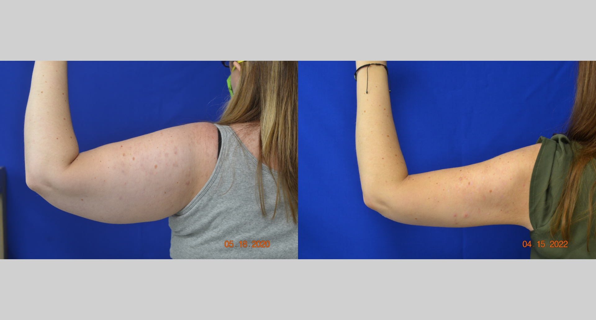 Before and After Image: Brachioplasty - back