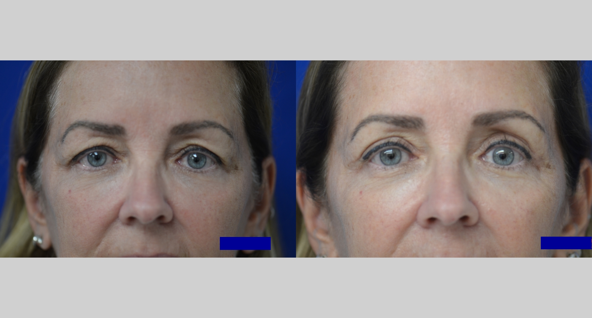 Before and After Image: Eyelid Surgery (Blepharoplasty) - front
