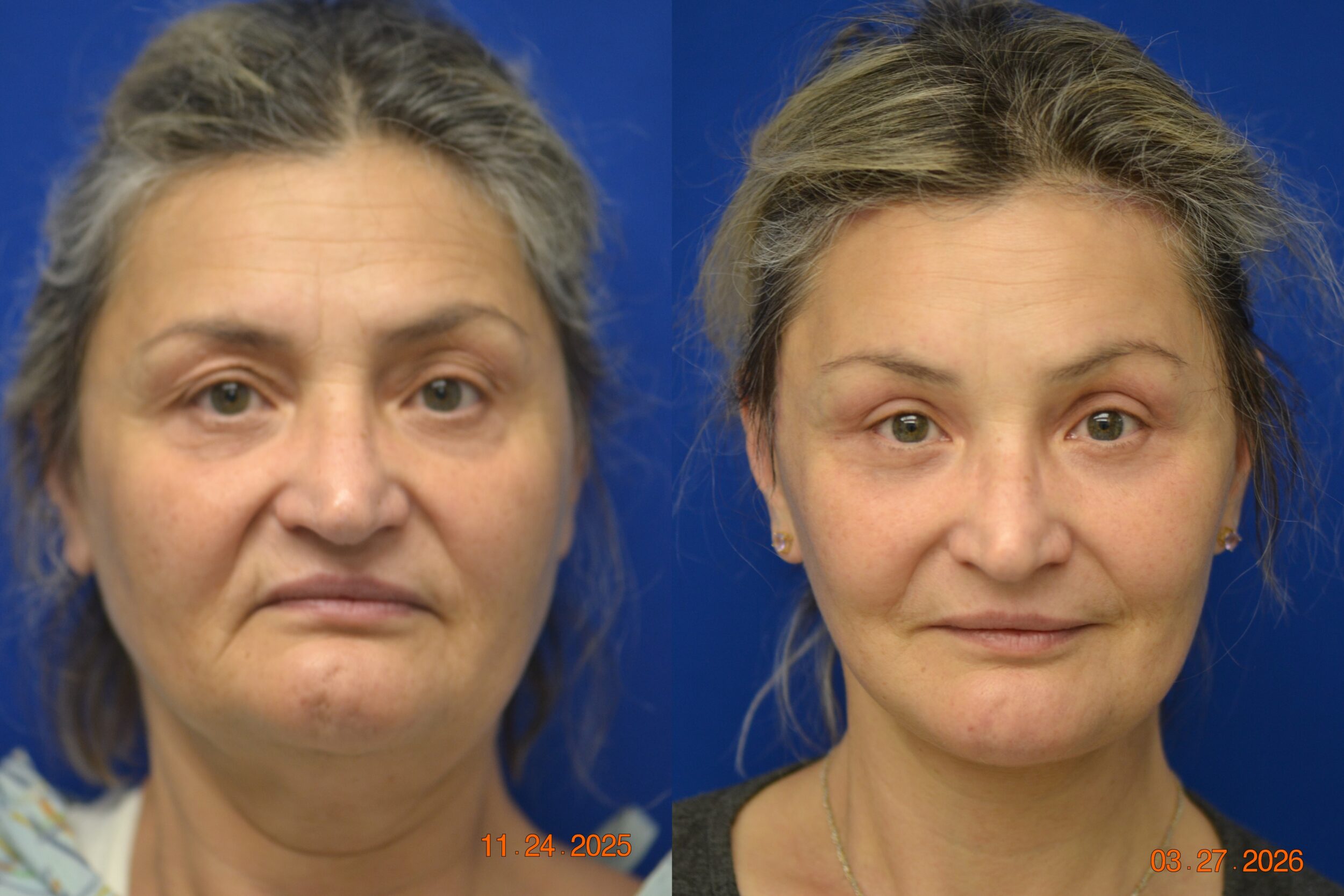 Before and After Image: Facelift - front