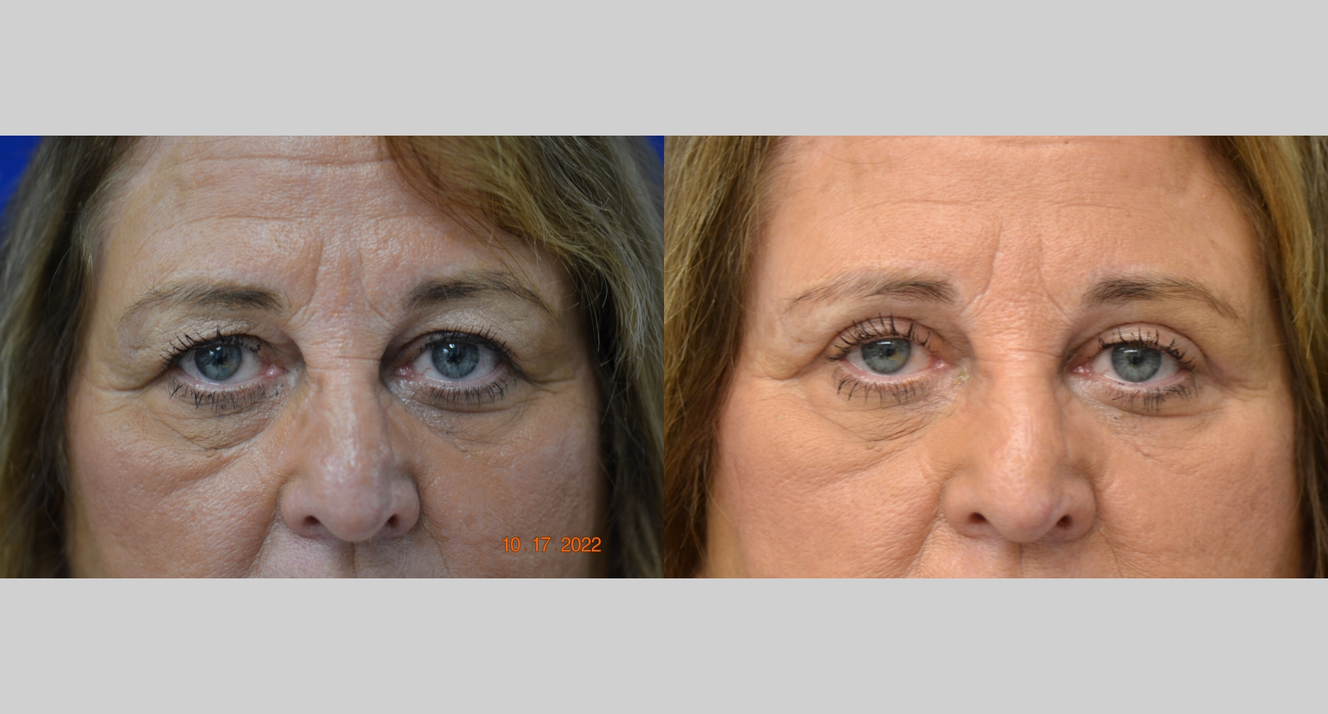 Before and After Image: Eyelid Surgery (Blepharoplasty) - front