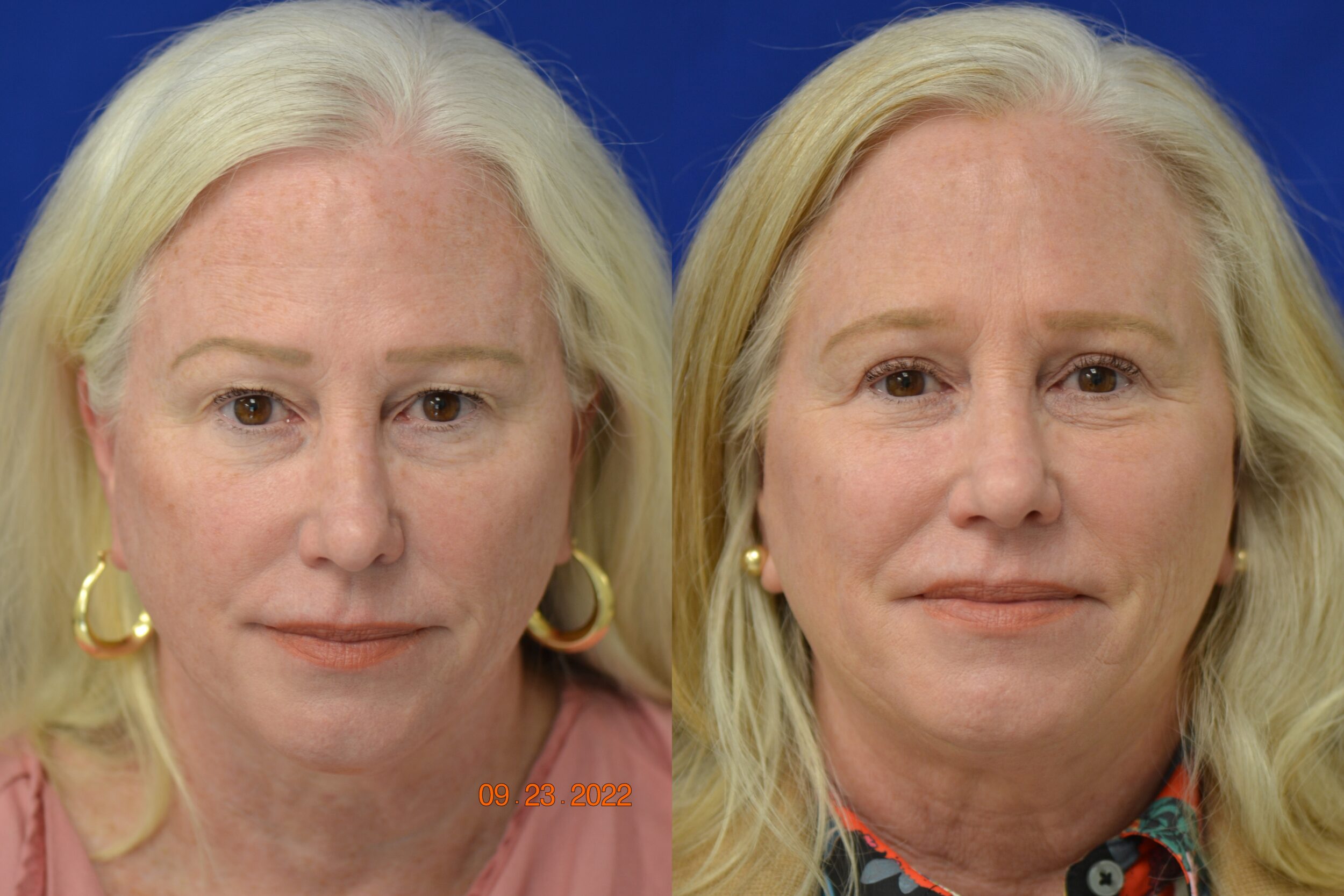 Before and After Image: Eyelid Surgery (Blepharoplasty) - front