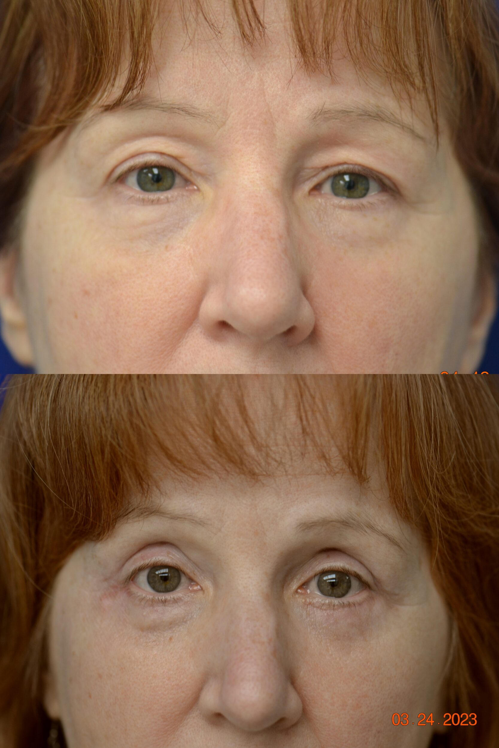 Before and After Image: Eyelid Surgery (Blepharoplasty) - front
