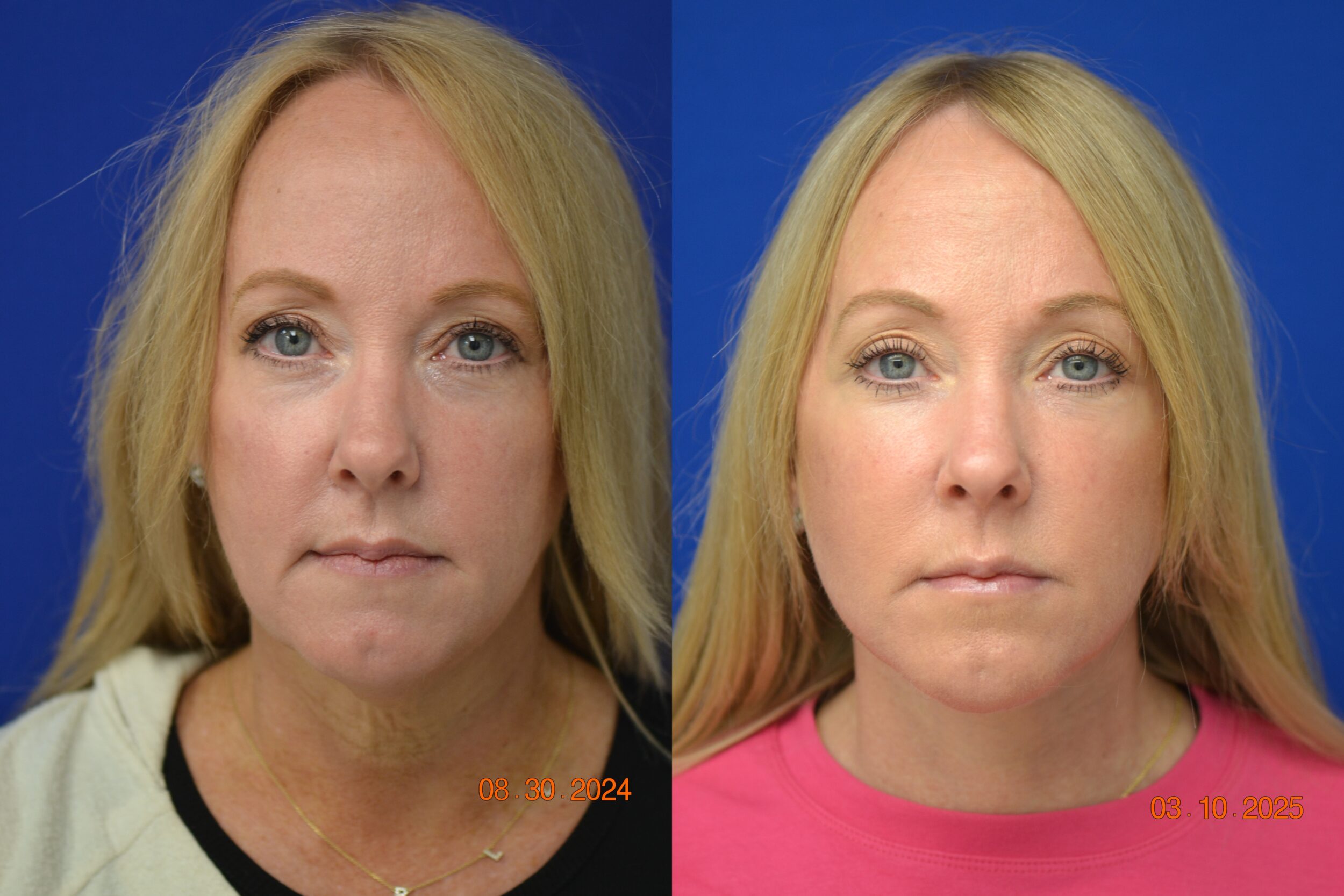 Before and After Image: Facelift - front