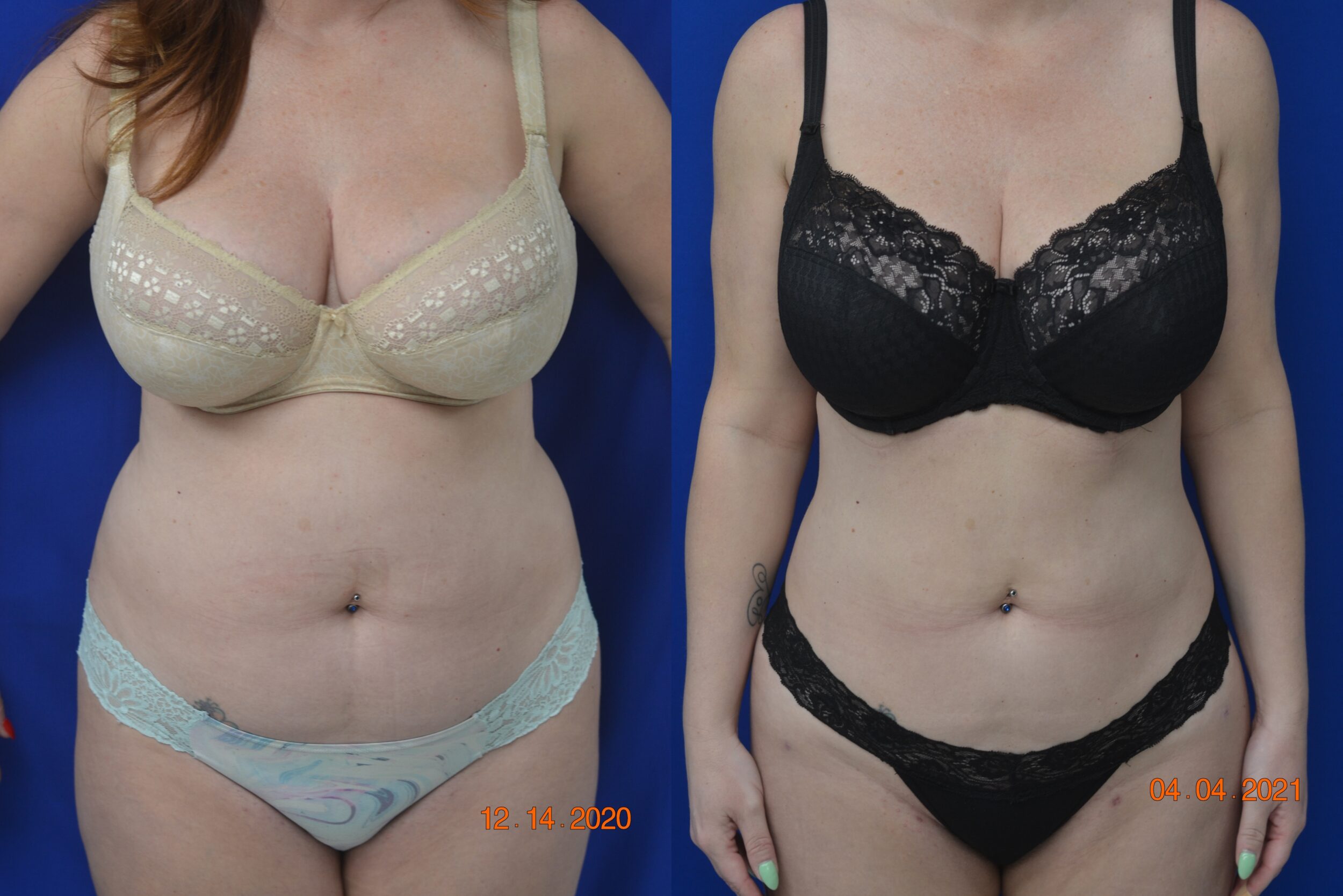Before and After Image: Liposuction - front