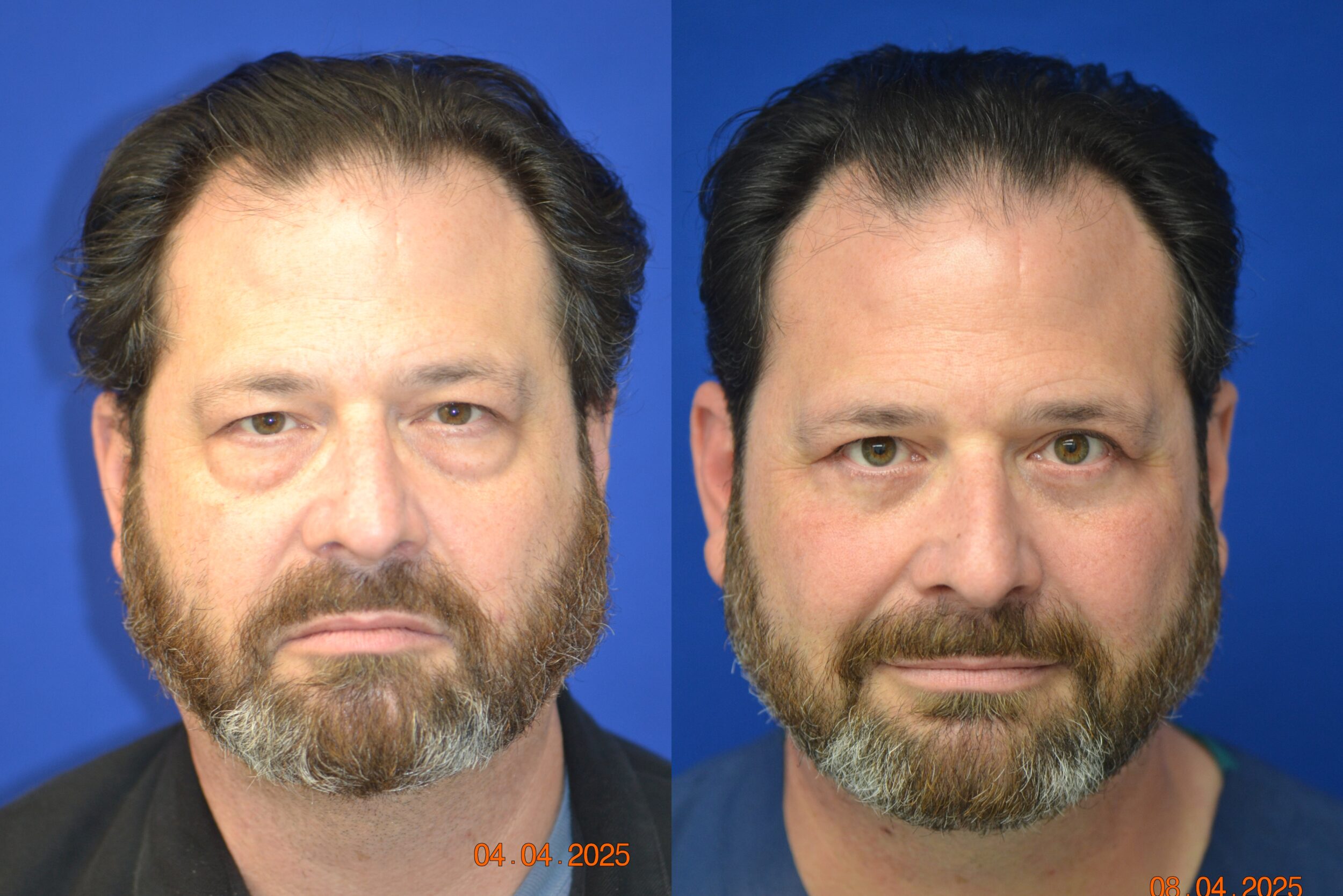 Before and After Image: Eyelid Surgery (Blepharoplasty) - front