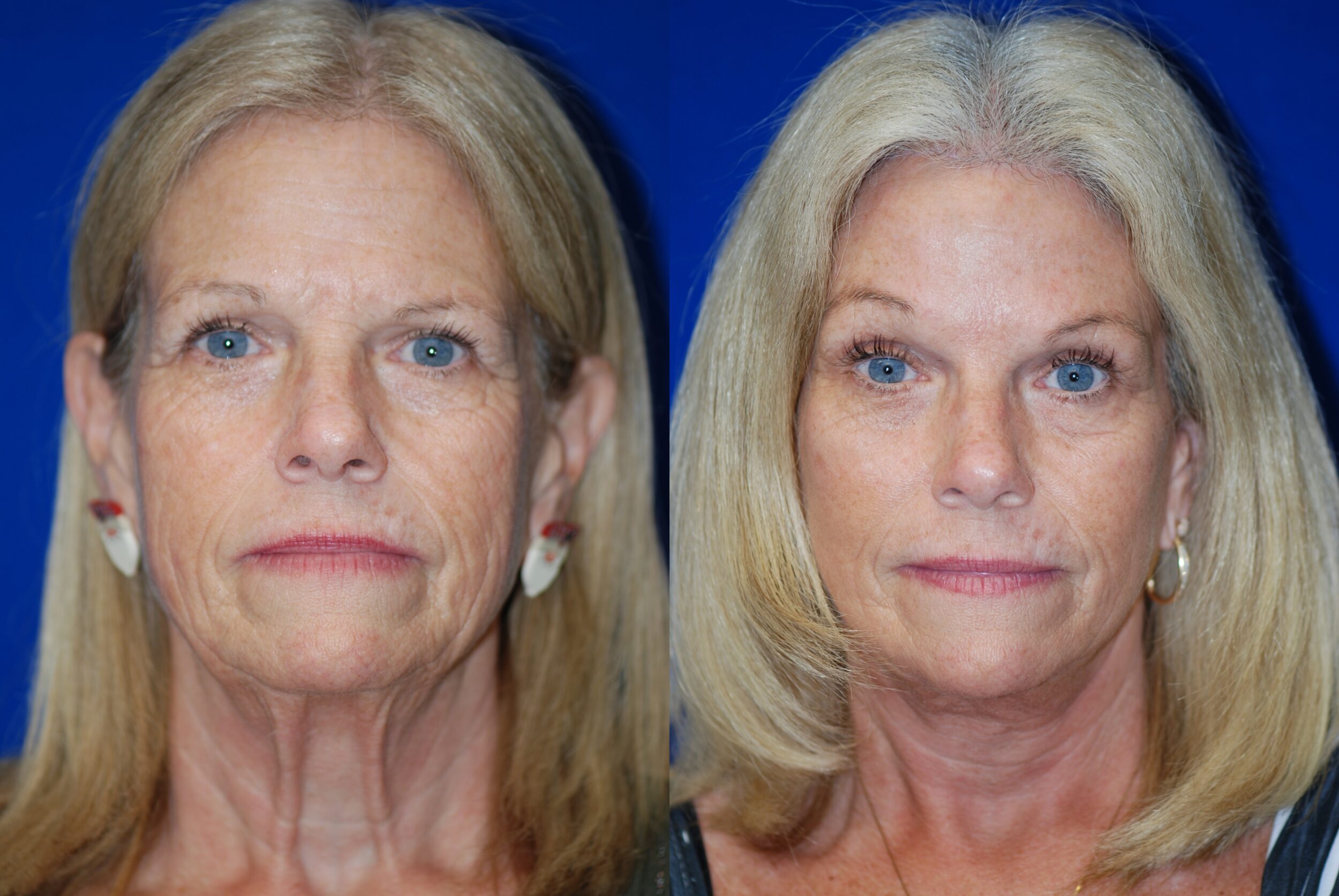 Before and After Image: Facelift - front