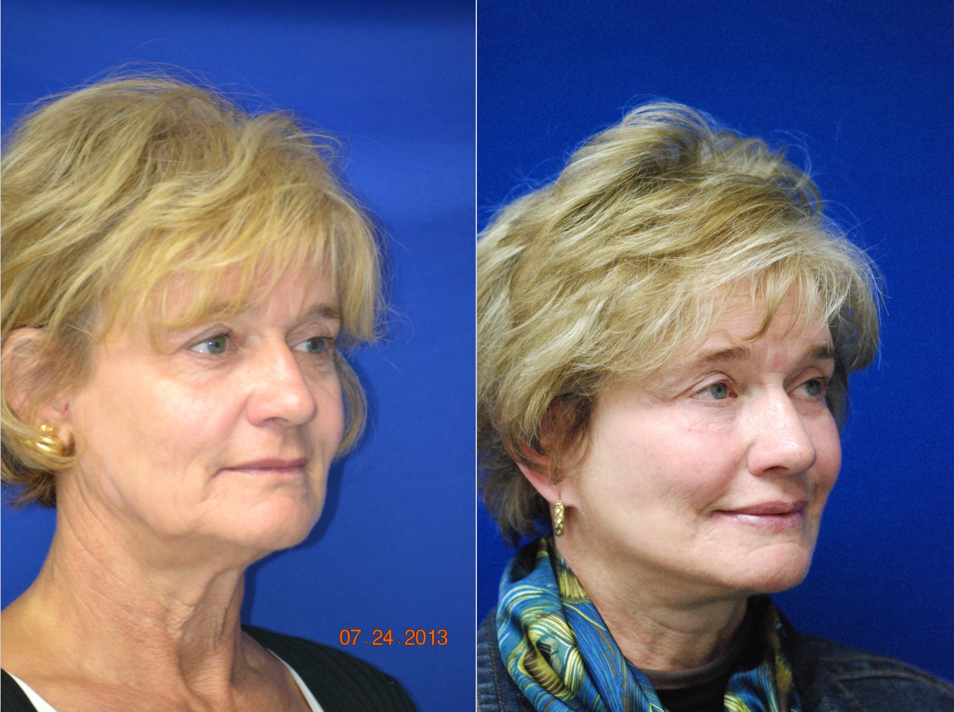Before and After Image: Facelift - right-front-oblique