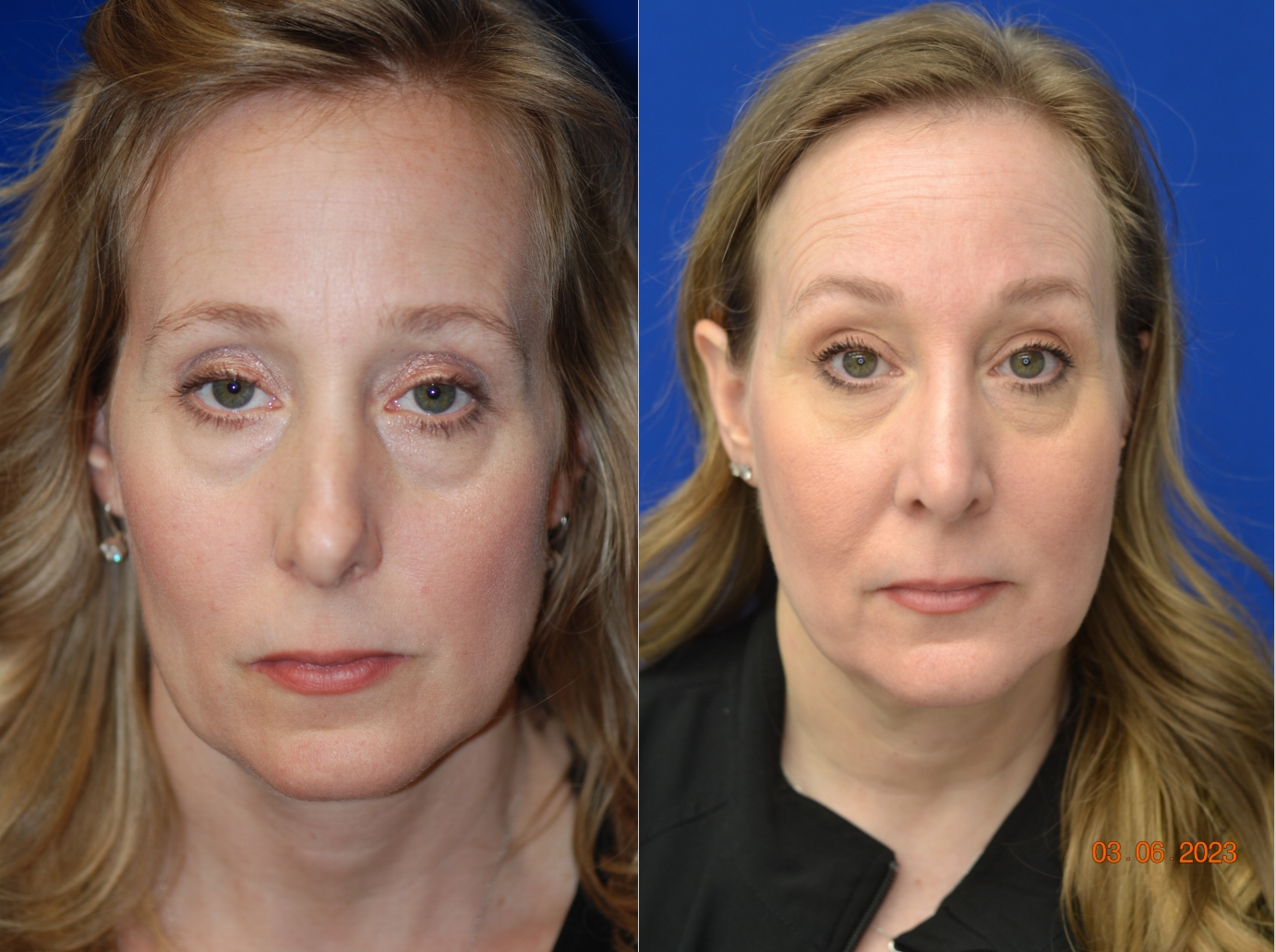 Before and After Image: Rhinoplasty - front