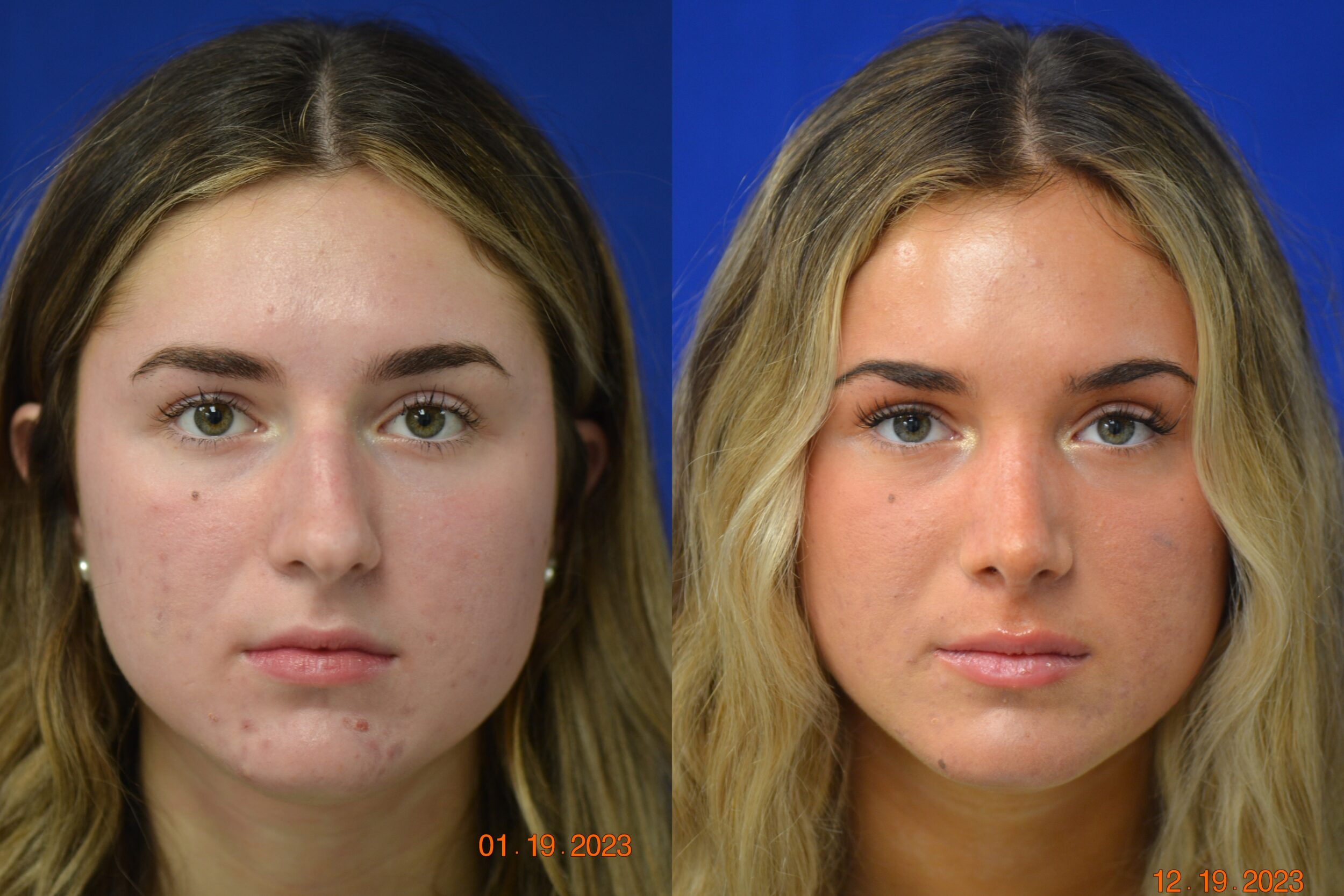 Before and After Image: Rhinoplasty - front