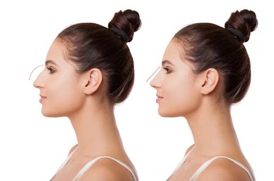 Before and after photos show a woman's nose with more balance after rhinoplasty.
