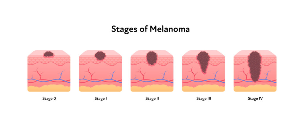 Illustrated diagram shows the many stages of skin cancer.